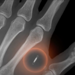 Chipet ültetett a kezébe, hogy Bitcoinnal fizethessen