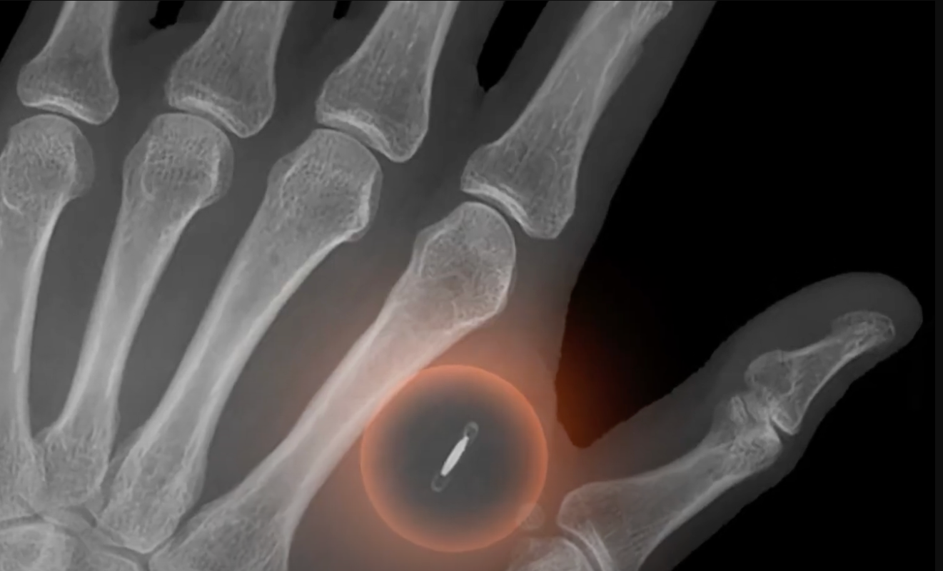 Chipet ültetett a kezébe, hogy Bitcoinnal fizethessen